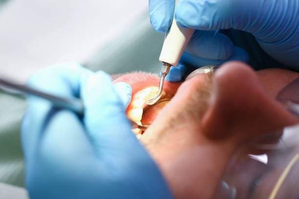 Best Knocked-Out Tooth (Avulsed Tooth) Treatment in Streamwood, IL